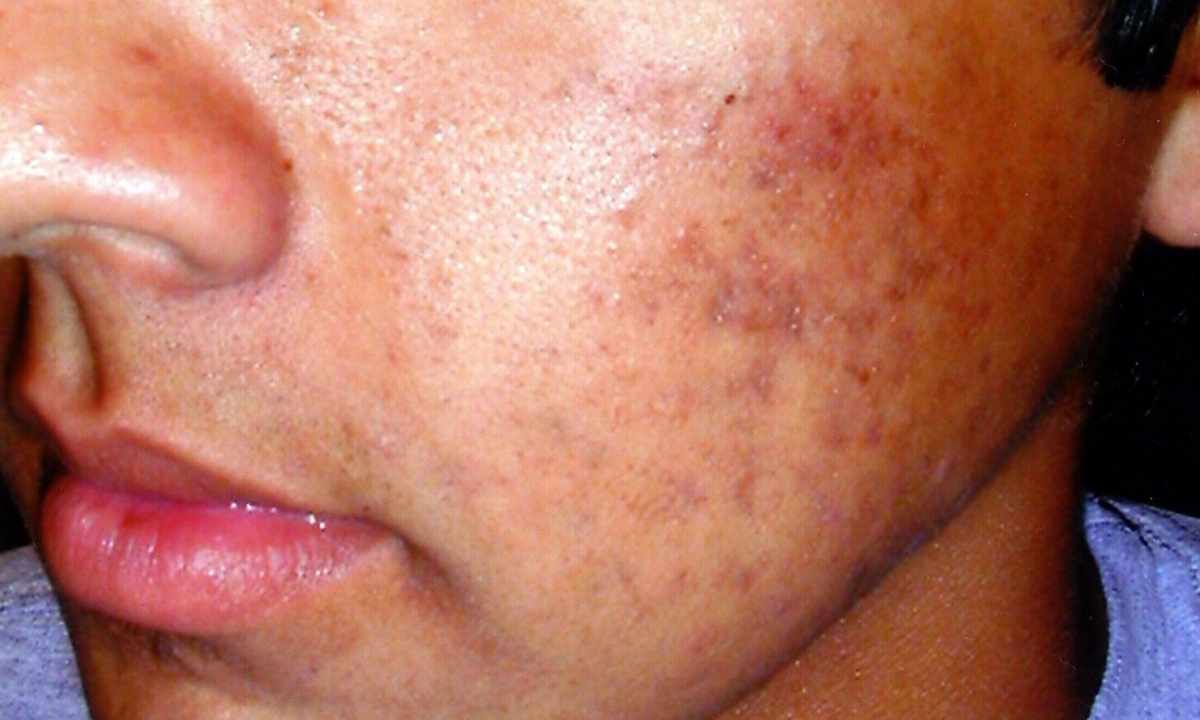How to remove pigmental spots on face